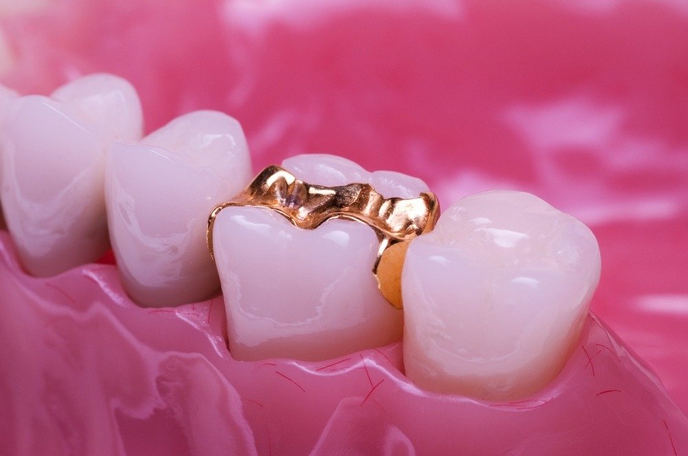 Dental cavity fillings and crowns in Weddington, near Wesley Chapel and Waverly, NC.
