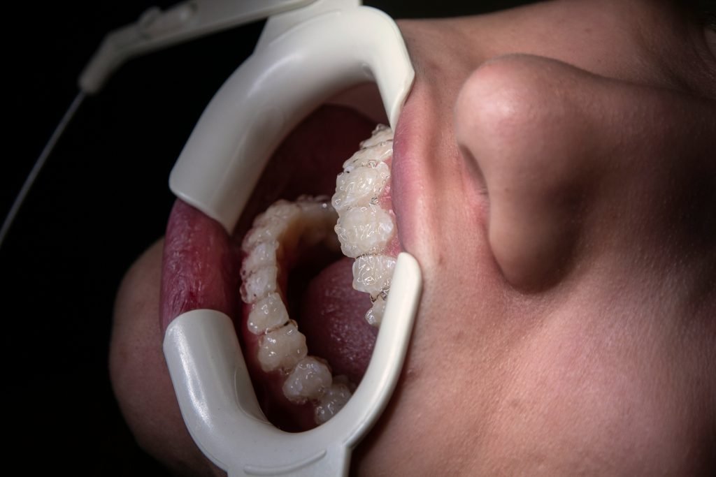 Holiday Cheer, Not Dental Fear: Root Canal Tips for Year-End Success